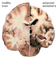 Conozcamos algo más sobre el Alzheimer